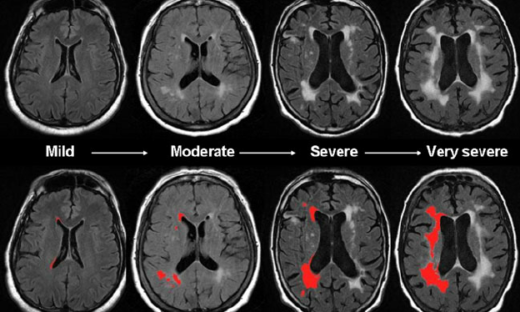 白質病変MRI