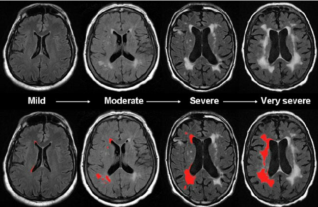 白質病変MRI